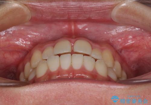 すきっ歯とオープンバイトをインビザラインで改善の治療前