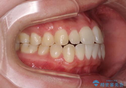 すきっ歯とオープンバイトをインビザラインで改善の治療前