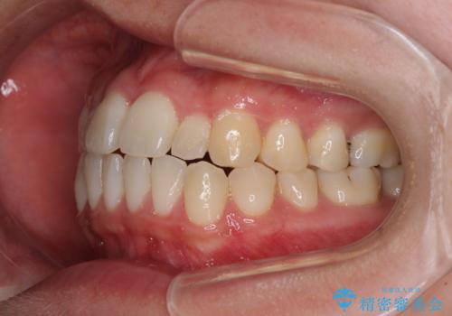 すきっ歯とオープンバイトをインビザラインで改善の治療前