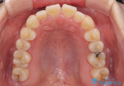 すきっ歯とオープンバイトをインビザラインで改善の治療前