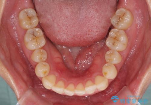 すきっ歯とオープンバイトをインビザラインで改善の治療前