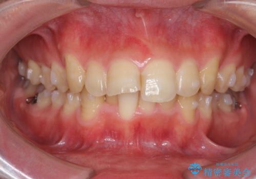 ガタつきの大きい前歯　インビザラインによるマウスピース矯正治療の治療中