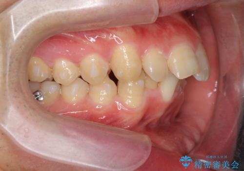 ガタつきの大きい前歯　インビザラインによるマウスピース矯正治療の治療中