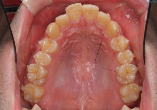ガタつきの大きい前歯 インビザラインによるマウスピース矯正治療の治療中