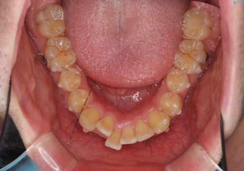 ガタつきの大きい前歯 インビザラインによるマウスピース矯正治療の治療中