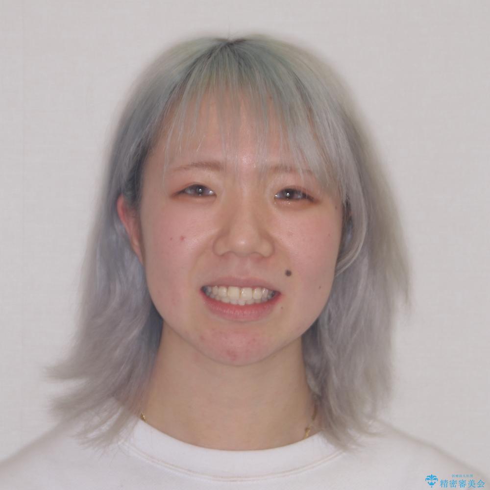 【モニター】八重歯を抜歯矯正でスッキリした口元にの治療後(顔貌)