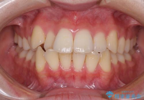 【モニター】前歯の前突感とクロスバイトをインビザラインで改善の症例 治療前