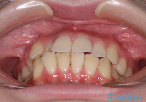 【モニター】前歯の前突感とクロスバイトをインビザラインで改善の治療前