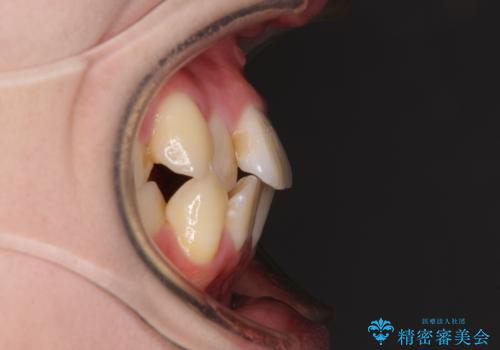 【モニター】前歯の前突感とクロスバイトをインビザラインで改善の治療前