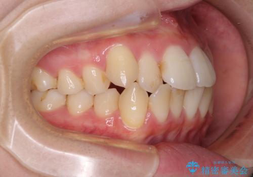 【モニター】前歯の前突感とクロスバイトをインビザラインで改善の治療前