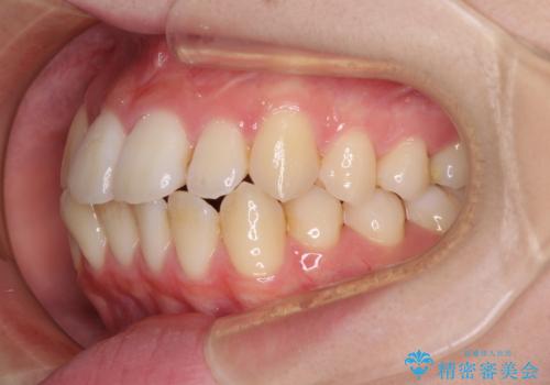 【モニター】前歯の前突感とクロスバイトをインビザラインで改善の治療前