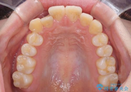 【モニター】前歯の前突感とクロスバイトをインビザラインで改善の治療前