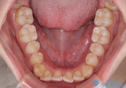 【モニター】前歯の前突感とクロスバイトをインビザラインで改善の治療前