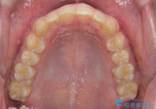 ガタつきの大きい前歯　インビザラインによるマウスピース矯正治療の治療後