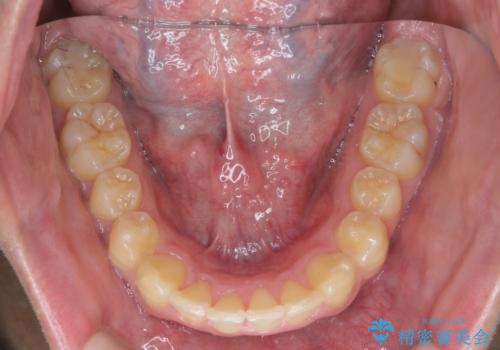ガタつきの大きい前歯 インビザラインによるマウスピース矯正治療の治療後