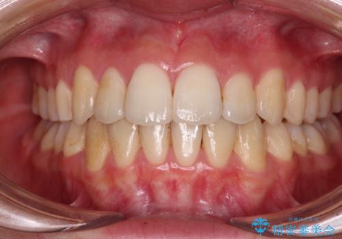 【モニター】前歯の前突感とクロスバイトをインビザラインで改善の症例 治療後