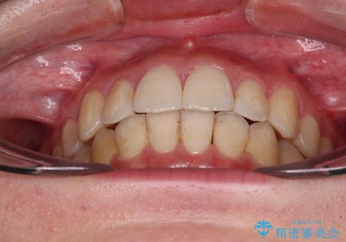 【モニター】前歯の前突感とクロスバイトをインビザラインで改善の治療後