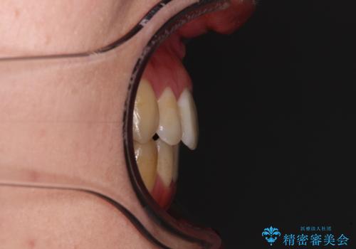 【モニター】前歯の前突感とクロスバイトをインビザラインで改善の治療後