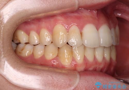 【モニター】前歯の前突感とクロスバイトをインビザラインで改善の治療後