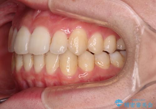 【モニター】前歯の前突感とクロスバイトをインビザラインで改善の治療後