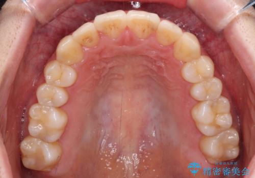 【モニター】前歯の前突感とクロスバイトをインビザラインで改善の治療後