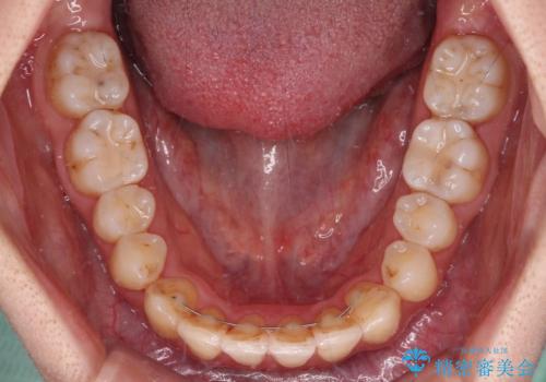 【モニター】前歯の前突感とクロスバイトをインビザラインで改善の治療後