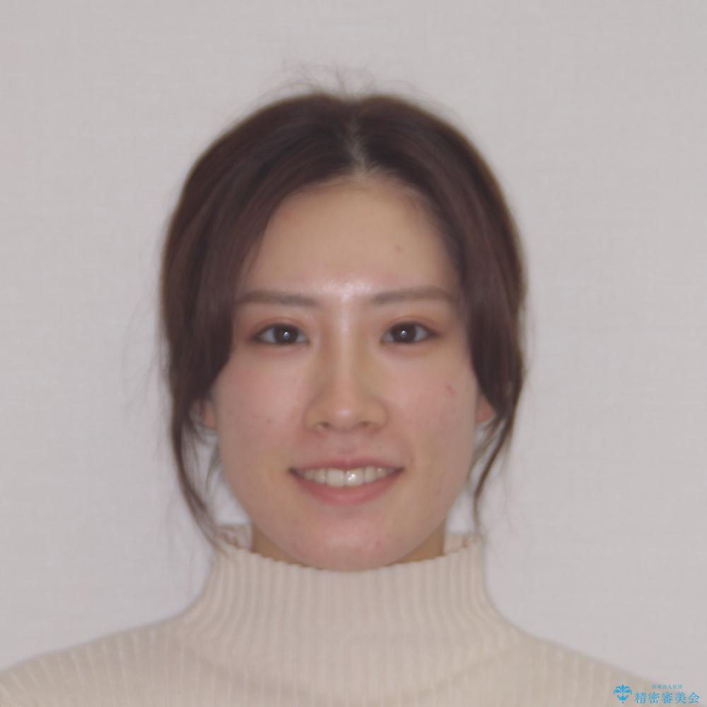 【モニター】前歯の前突感とクロスバイトをインビザラインで改善の治療後(顔貌)