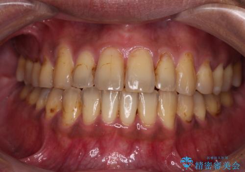 前歯のクロスバイトを改善　ワイヤー装置での非抜歯矯正の治療後