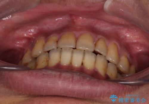 前歯のクロスバイトを改善 ワイヤー装置での非抜歯矯正の治療後