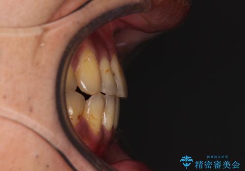 前歯のクロスバイトを改善 ワイヤー装置での非抜歯矯正の治療後