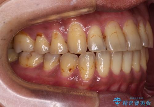 前歯のクロスバイトを改善 ワイヤー装置での非抜歯矯正の治療後