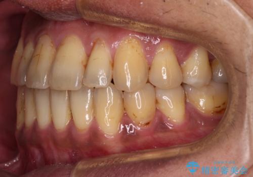 前歯のクロスバイトを改善 ワイヤー装置での非抜歯矯正の治療後