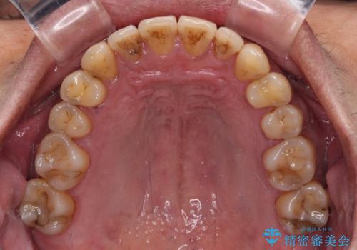 前歯のクロスバイトを改善 ワイヤー装置での非抜歯矯正の治療後