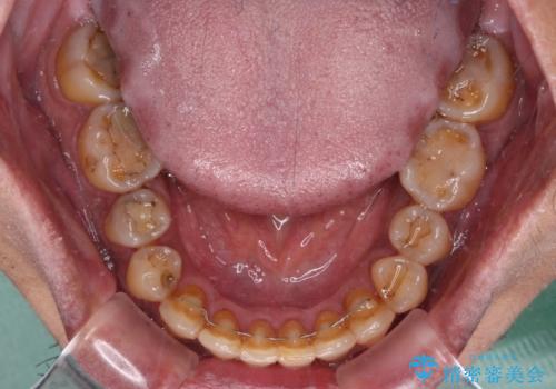 前歯のクロスバイトを改善 ワイヤー装置での非抜歯矯正の治療後