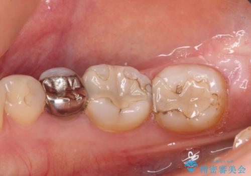 下の奥歯の虫歯をゴールドインレーで治療の症例 治療前