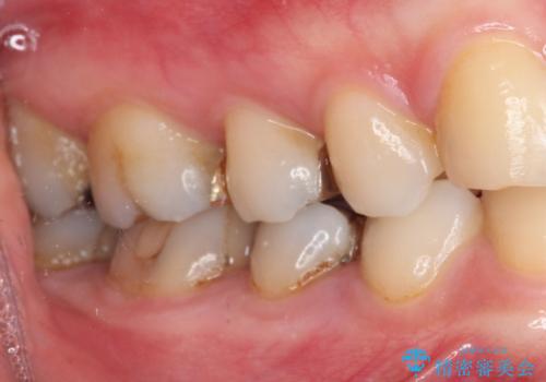 下の奥歯の虫歯をゴールドインレーで治療の治療前
