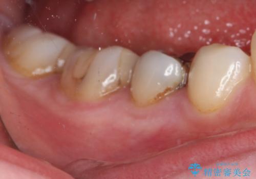 下の奥歯の虫歯をゴールドインレーで治療の治療前