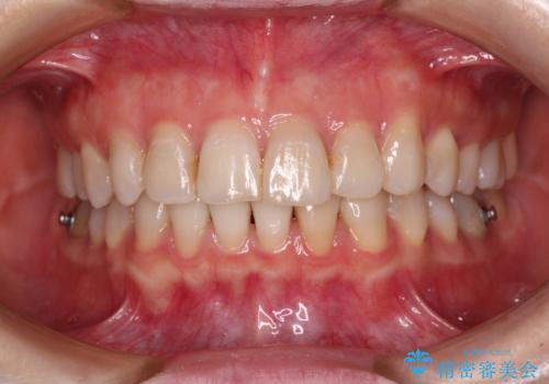 前歯の突出感とデコボコをインビザライン矯正で改善の治療中