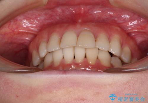 前歯の突出感とデコボコをインビザライン矯正で改善の治療中