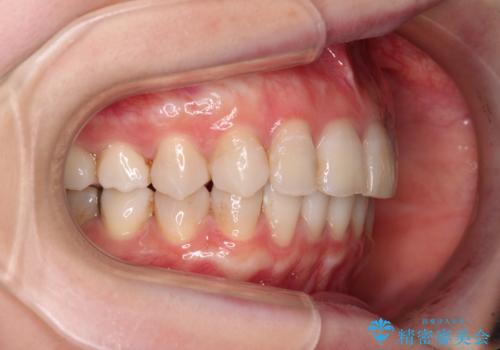 前歯の突出感とデコボコをインビザライン矯正で改善の治療中