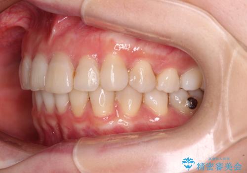 前歯の突出感とデコボコをインビザライン矯正で改善の治療中