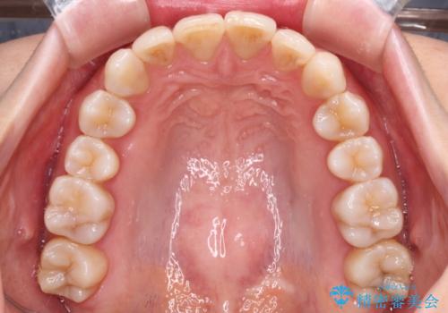前歯の突出感とデコボコをインビザライン矯正で改善の治療中