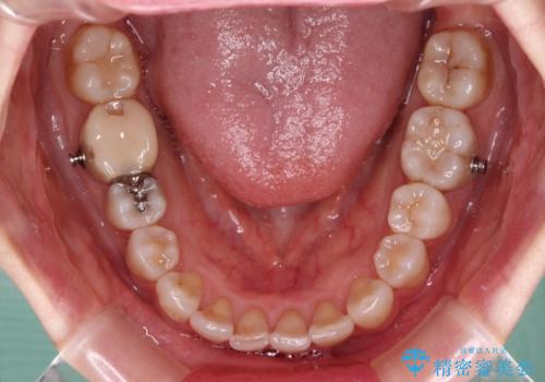 前歯の突出感とデコボコをインビザライン矯正で改善の治療中