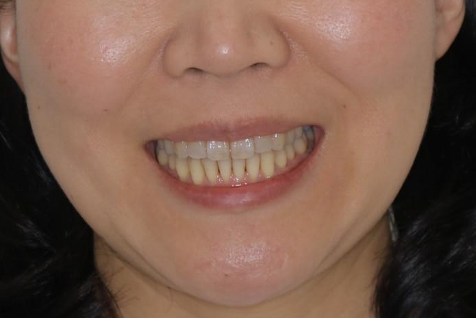歯ぐき、骨が薄い方のマウスピース矯正治療　非抜歯でもIPR(歯を削る処置)で口元に変化をの治療後（顔貌）