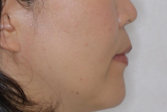 歯ぐき、骨が薄い方のマウスピース矯正治療 非抜歯でもIPR(歯を削る処置)で口元に変化をの治療後(顔貌)