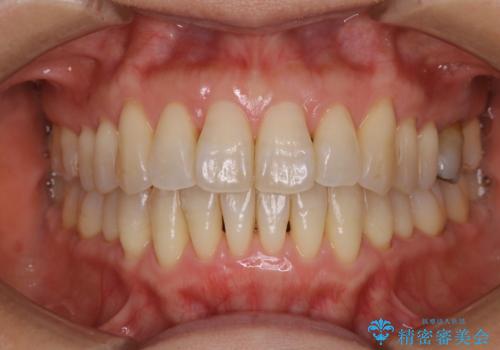 歯ぐき、骨が薄い方のマウスピース矯正治療　非抜歯でもIPR(歯を削る処置)で口元に変化をの症例 治療後