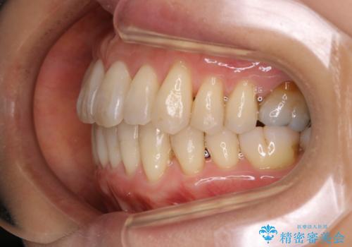 歯ぐき、骨が薄い方のマウスピース矯正治療 非抜歯でもIPR(歯を削る処置)で口元に変化をの治療後