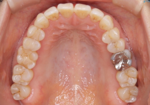 歯ぐき、骨が薄い方のマウスピース矯正治療　非抜歯でもIPR(歯を削る処置)で口元に変化をの治療後