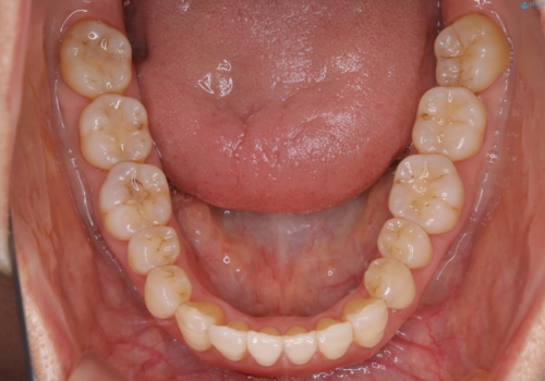 歯ぐき、骨が薄い方のマウスピース矯正治療　非抜歯でもIPR(歯を削る処置)で口元に変化をの治療後