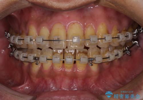前歯のクロスバイトを改善 ワイヤー装置での非抜歯矯正の治療中